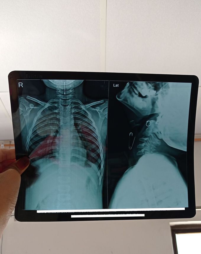 A boy swallowed 'sefety pin'