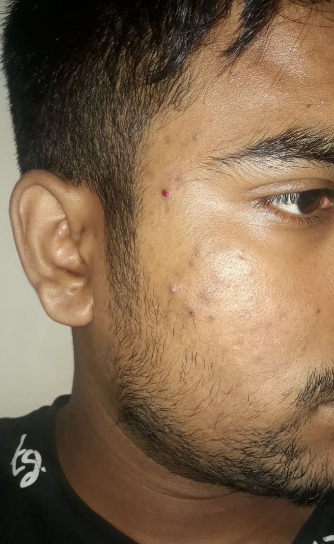 Which is the best treatment for removing acne scar.