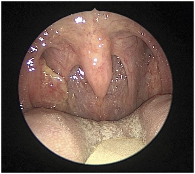 Tonsil Cancer