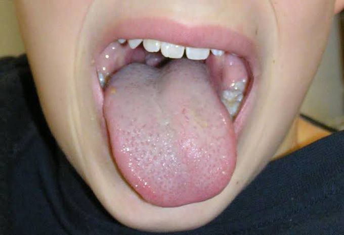 Tongue deviation