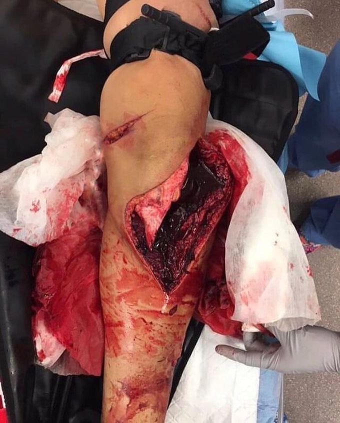 Boat accident causing a severe leg injury! 