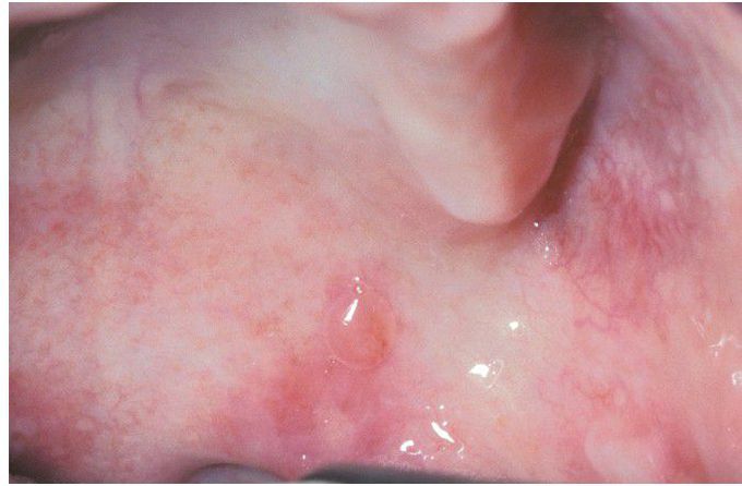 Mucous Membrane Pemphigoid