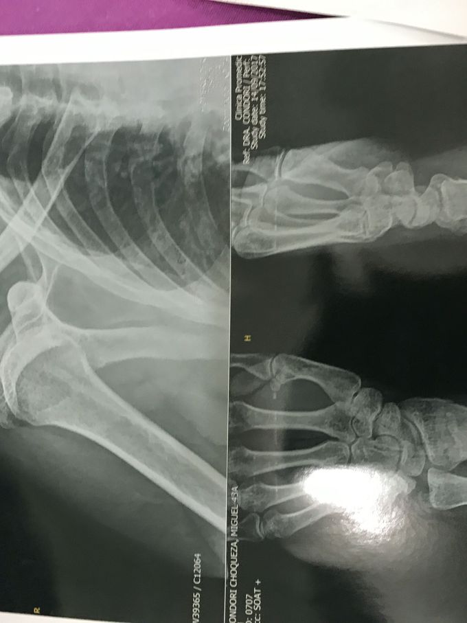 Fracture