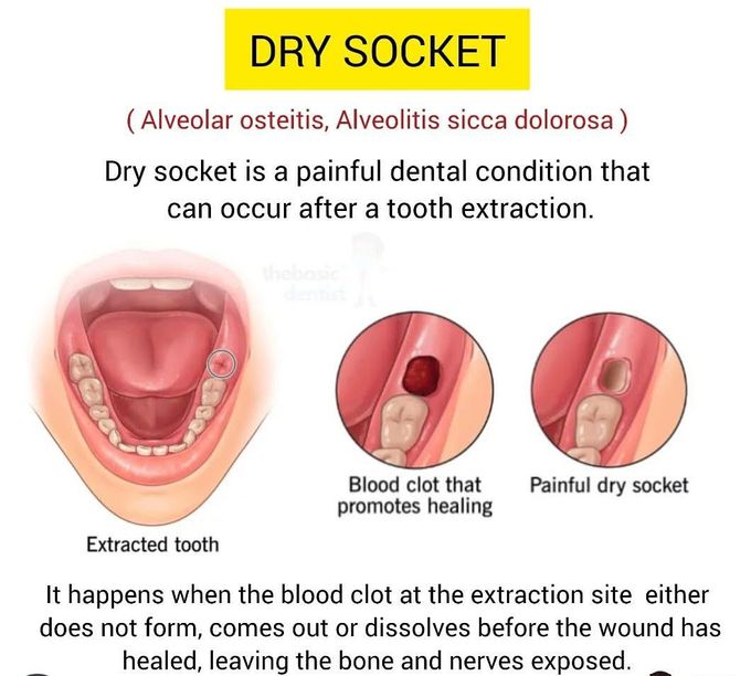 Dry Socket I