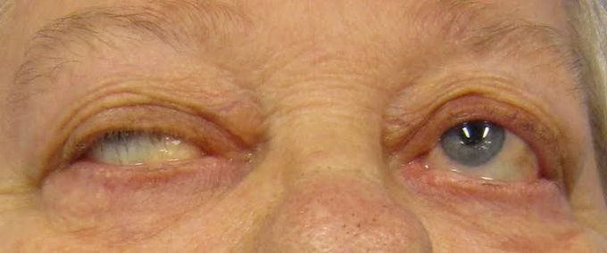 Myasthenia gravis