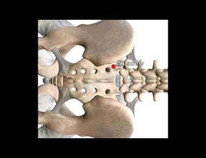 S-1 and S-2-alar-iliac screw fixation via intraoperative navigation