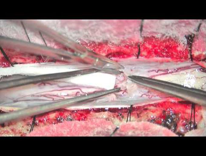 Dorsal arachnoid web