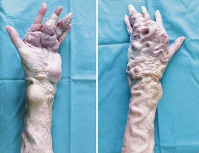 Patient suffering from Parkes Weber syndrome 