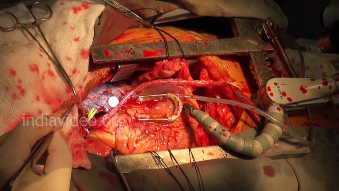 Live Open Heart Surgery 