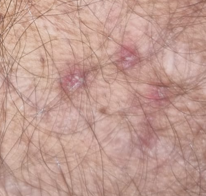 Red Itchy bumps on right thigh.