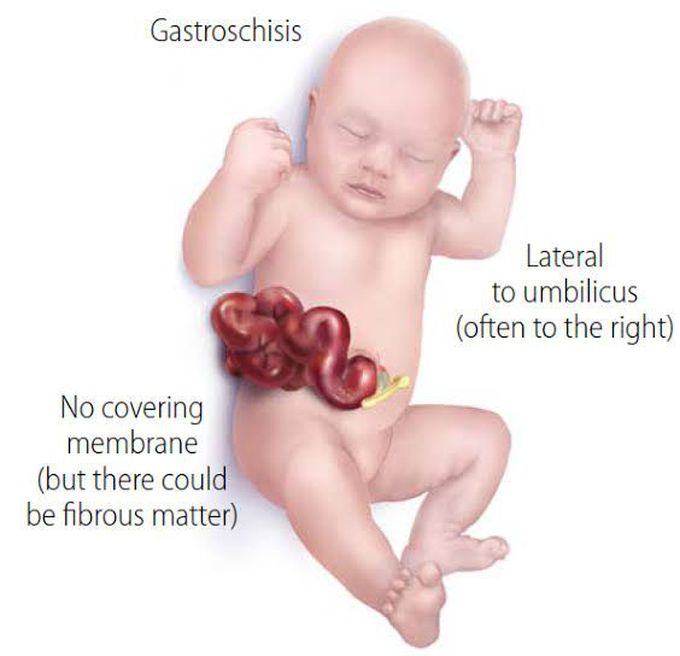 Gastroschisis