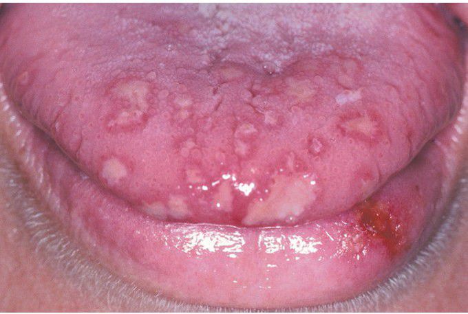 Acute Herpetic Gingivostomatitis