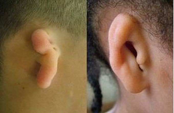 Microtia surgery and treatment