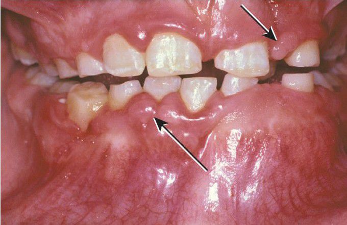 Tuberous Sclerosis.