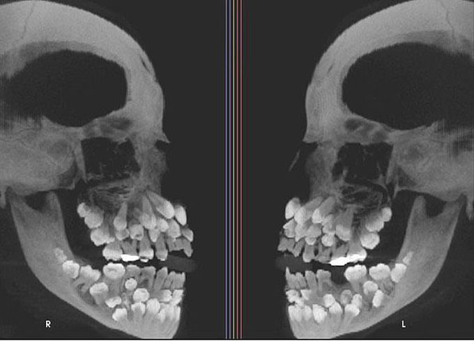  81 teeth in one mouth!