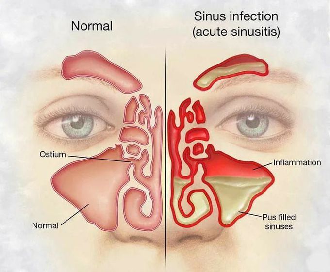 Normal Vs sinusitis