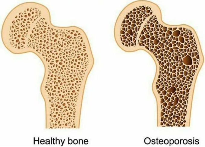 Pictorial differenciation of a healthy bone with a bone having osteporosis