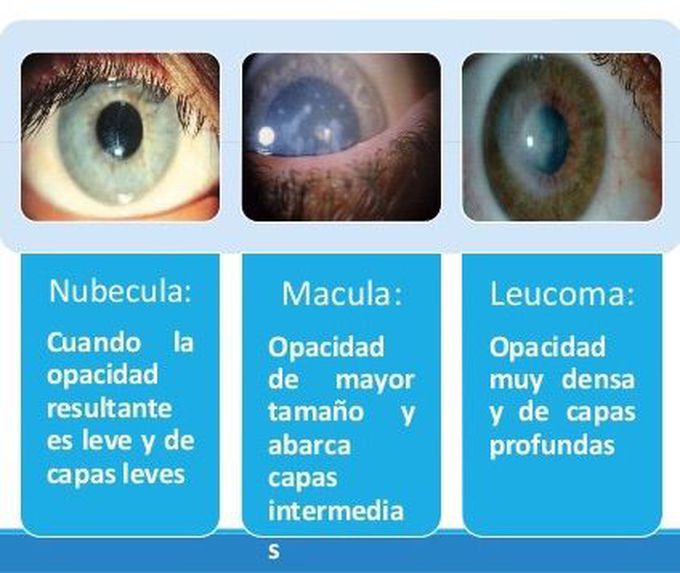Cicatriz corneal