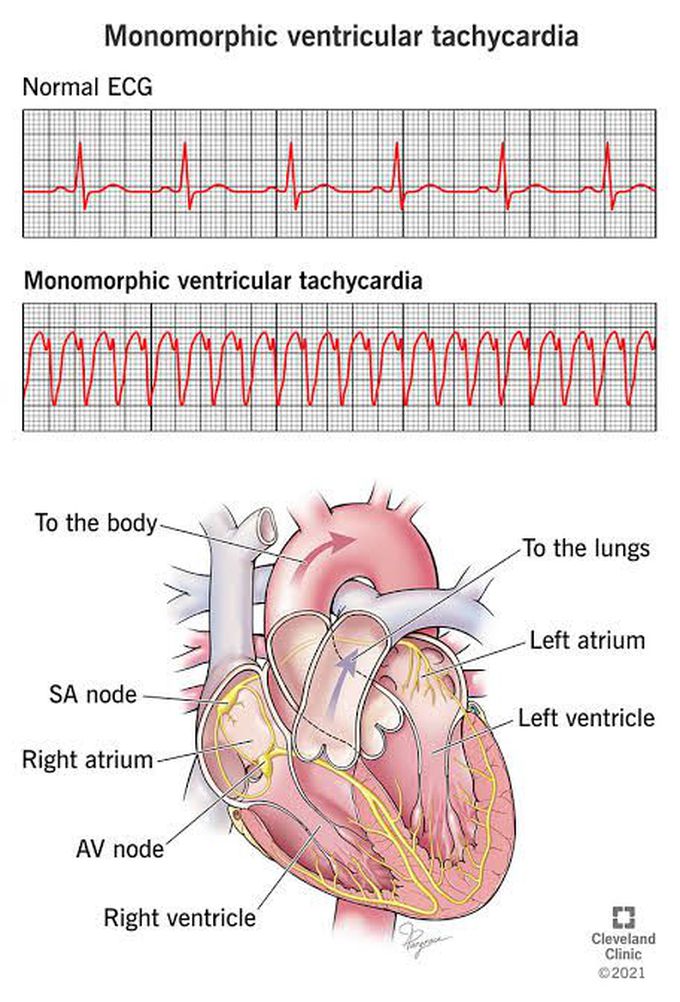 Monomorphic Ventricular Tachycardia