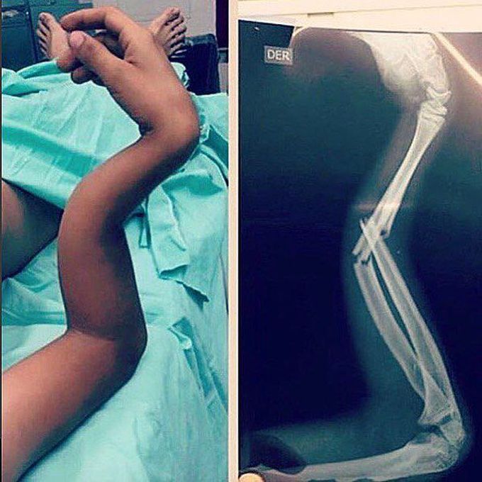 Fractured forearm!