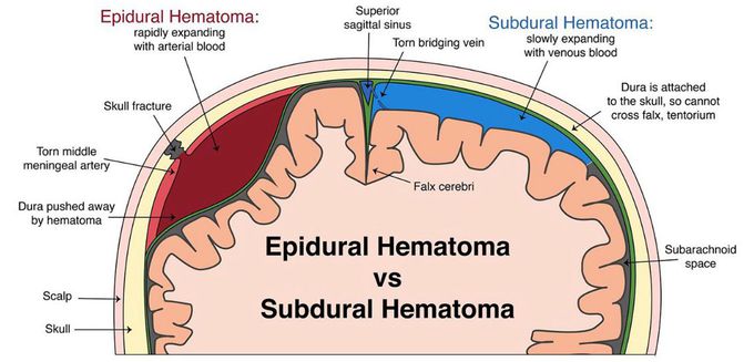 Epidural hematoma vs subdural hematoma