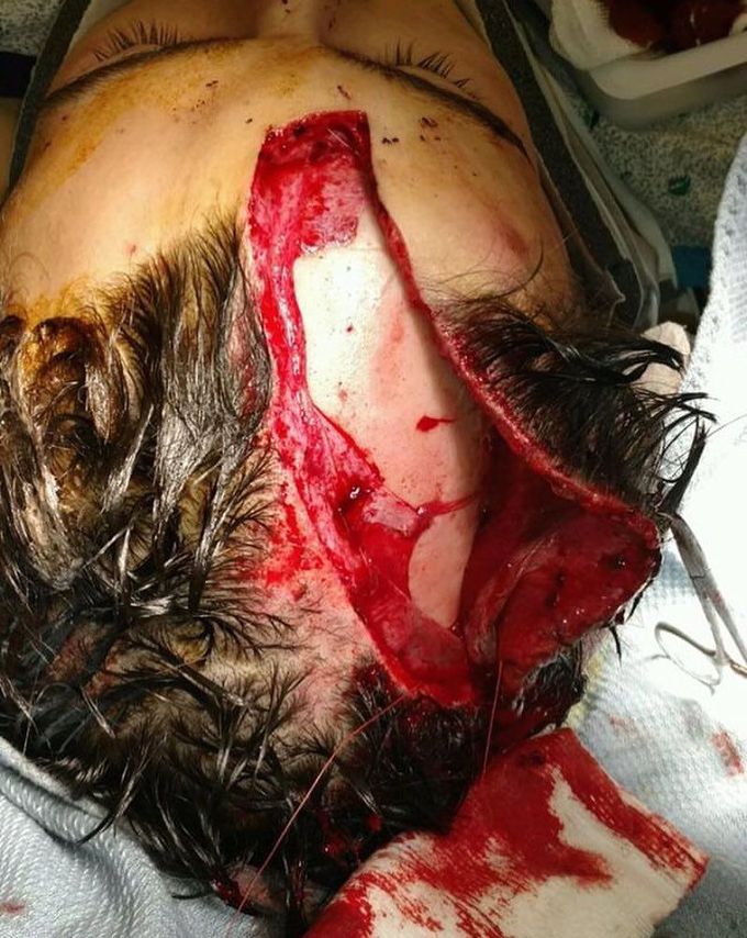 Extensive clean edge laceration injury to the scalp!! 