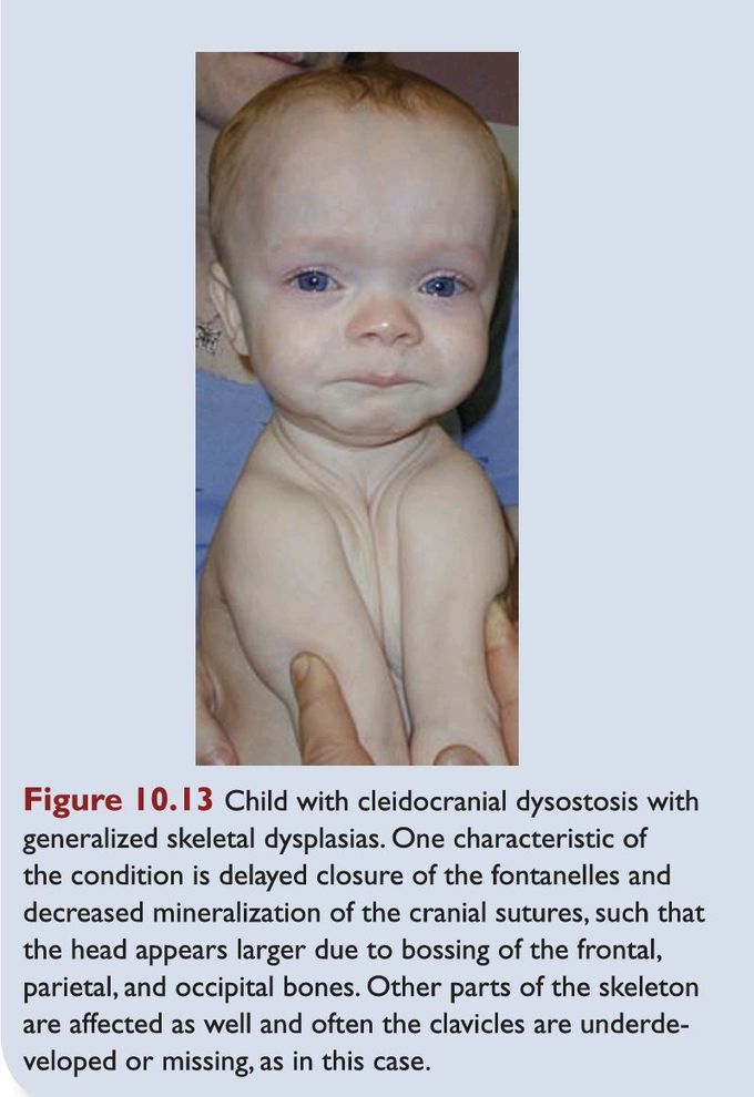 Abnormality in Skeletal System development