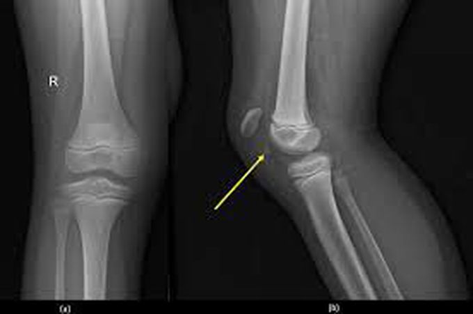 Platella fracture