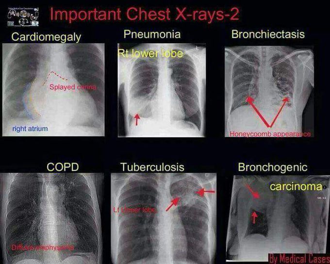 MEDizzy X rays Of Some Disorder Explain Please How To Read Them