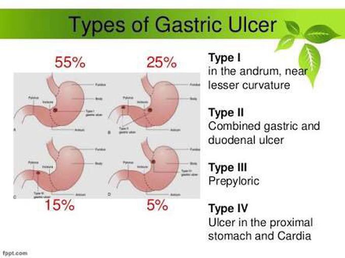 Types of gastric ulcers