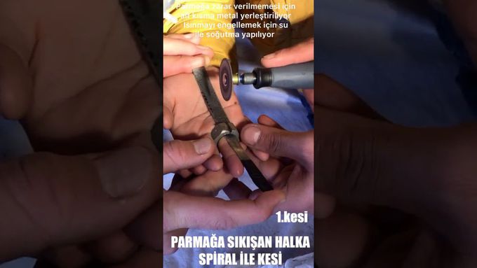 PARMAĞA SIKIŞMIŞ SOMUN VİDA ÇIKARILIŞI