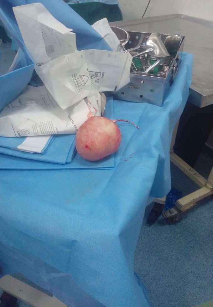 Thyriodectomy