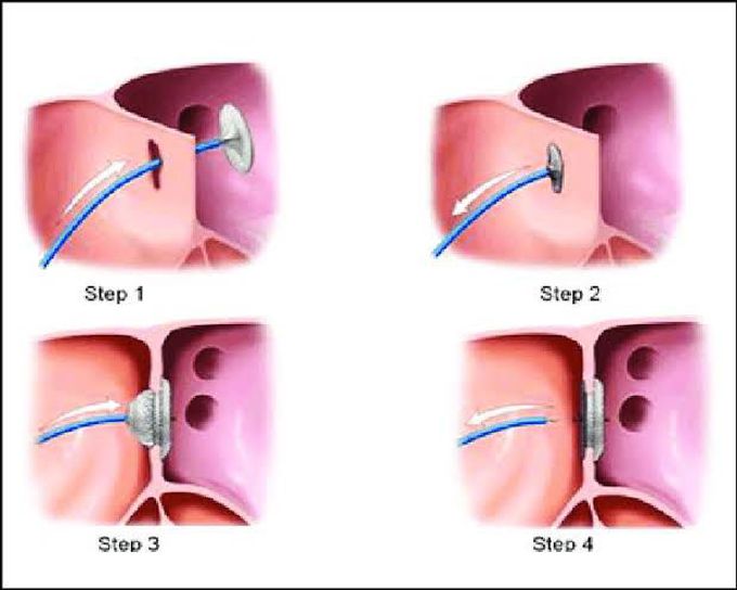 Transcatheter Device Closure of ASD