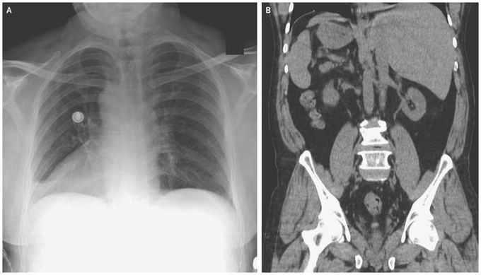Situs Inversus Totalis