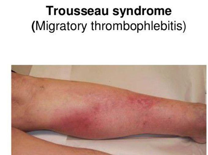 Treatment for Trousseau Syndrome