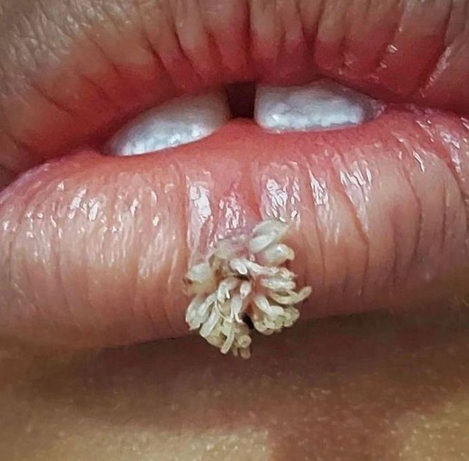 Filiform wart on the lip