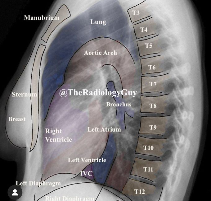 Chest Xray