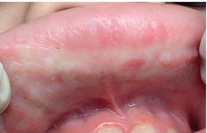 Lipoid Proteinosis.