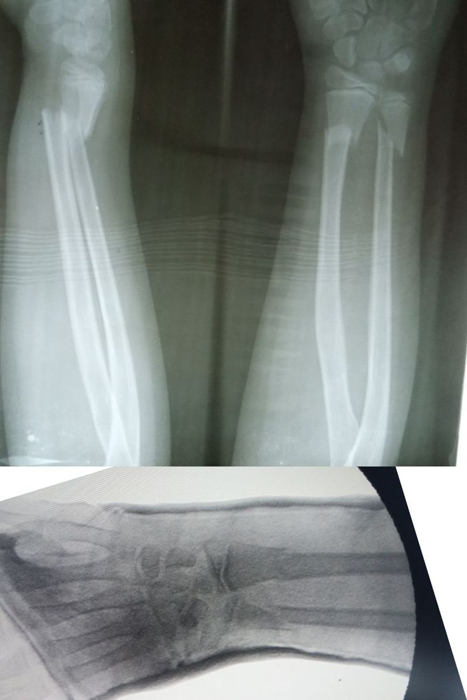 Fx distal radius & ulna