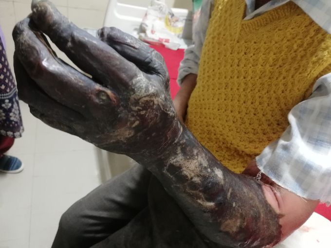 Gangrene of hand and forearm