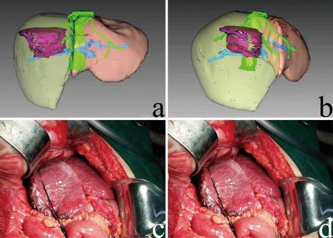 Hepatectomy