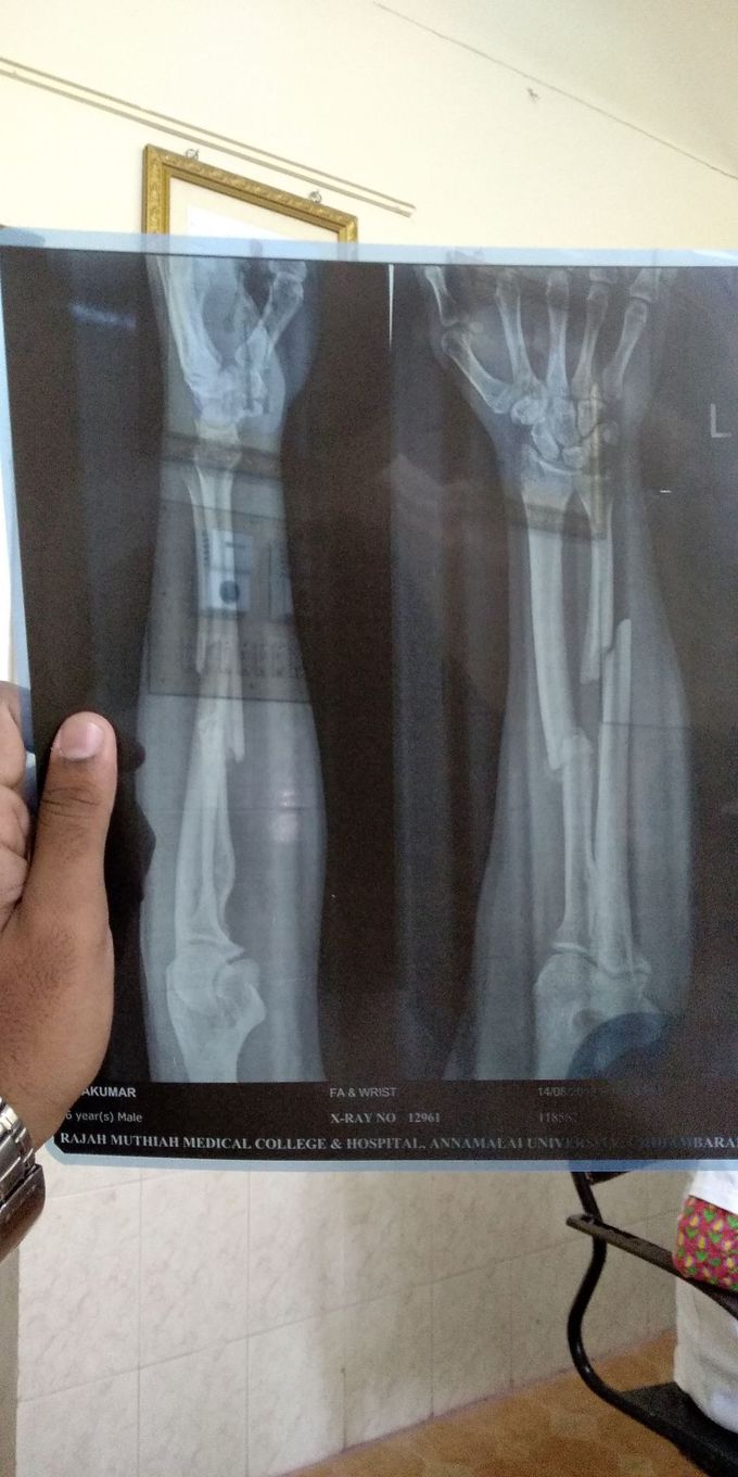 Compound fracture due to outstretched fall