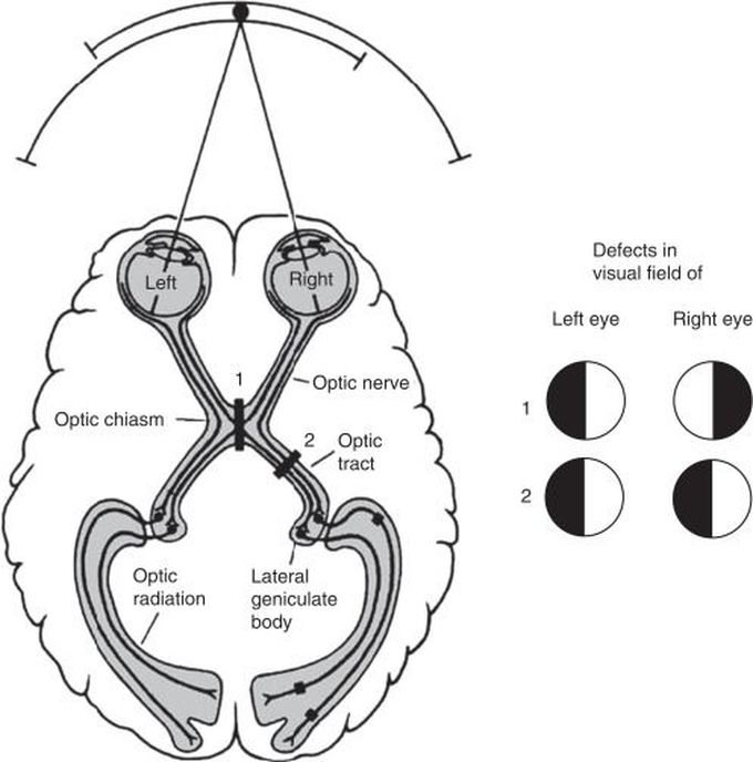 Optic chiasm