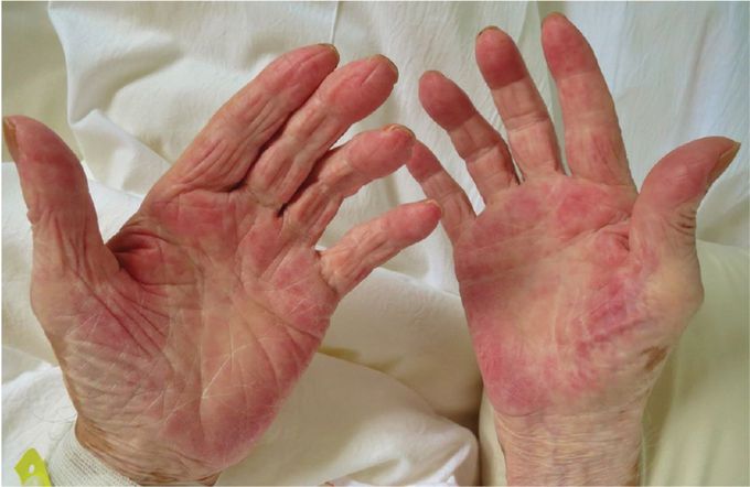 Palmer Erythema