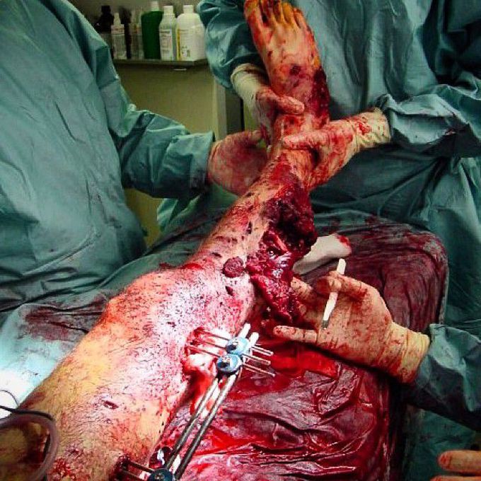 Severe leg trauma accompanied with open fractures of Tibia and Fibula