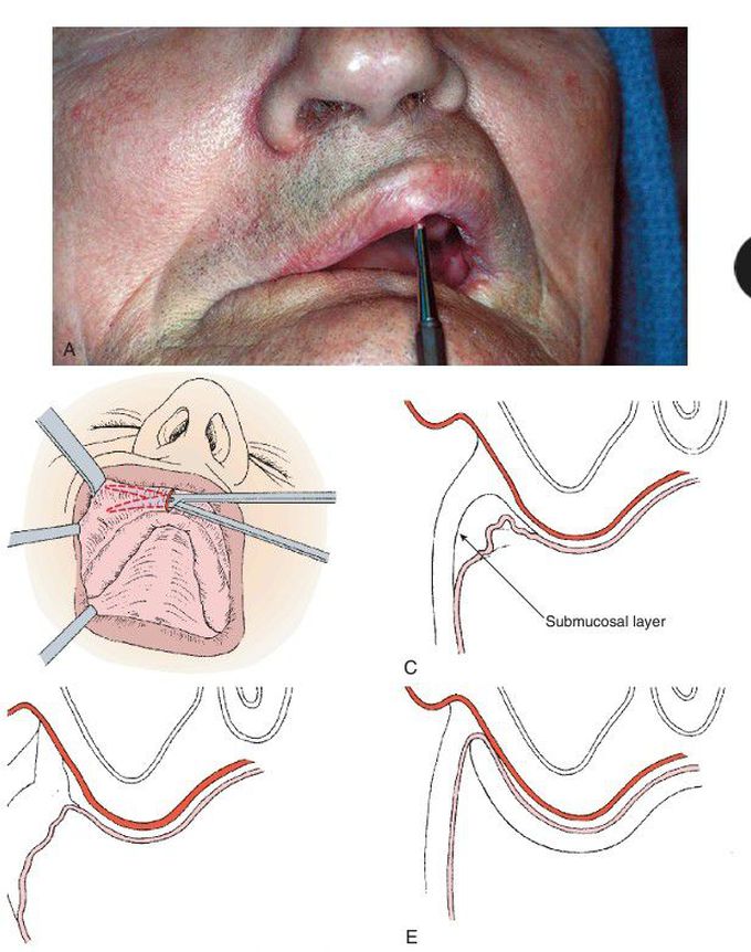 Submucosal vestibuloplasty