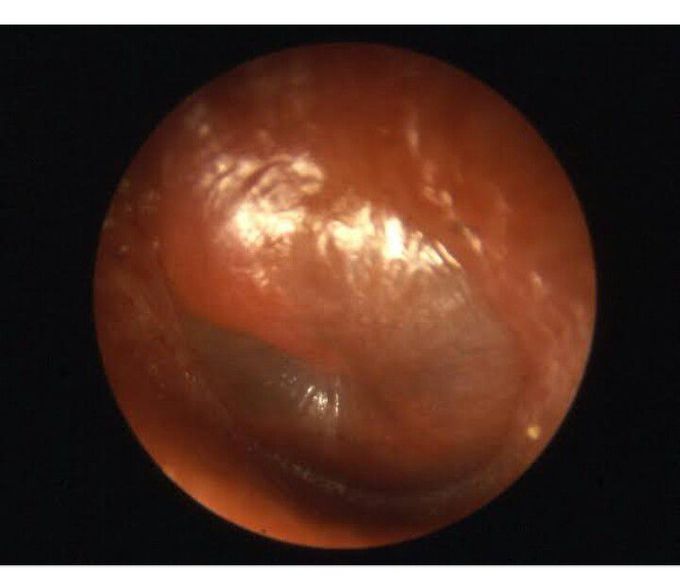 Acute Otitis Media