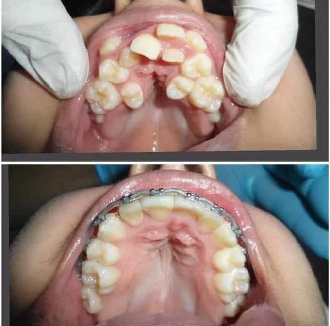 The art of braces