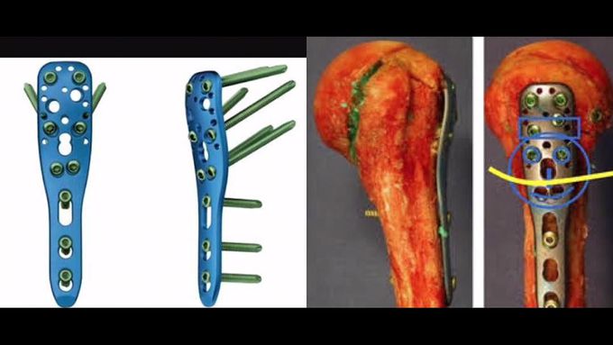 PHILOS (Proximal Humerus Internal Locking System)