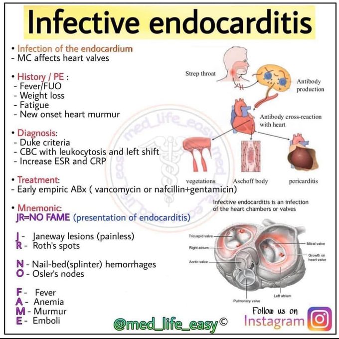 Infective endocarditis